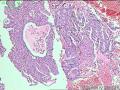 子宫内膜腺癌图1