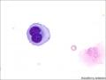 胸水细胞图4