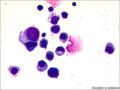 胸水细胞图6