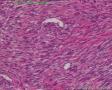 子宫肌瘤图15