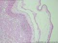 胎盘病理--羊膜绒毛膜炎图1