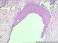 卵巢囊肿--囊性成熟型畸胎瘤？图4