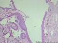 卵巢囊肿--囊性成熟型畸胎瘤？图2