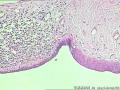 卵巢囊肿--囊性成熟型畸胎瘤？图6