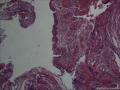 肾盂输尿管连接部息肉图9