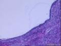 各位老师：盆腔小肿物又传新图，是否考虑浆液性腺纤维瘤？图16