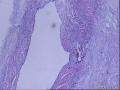 各位老师：盆腔小肿物又传新图，是否考虑浆液性腺纤维瘤？图25