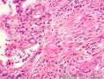 到底是子宫内膜样腺癌还是透明细胞癌图2
