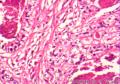 到底是子宫内膜样腺癌还是透明细胞癌图5