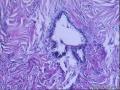 各位老师：盆腔小肿物又传新图，是否考虑浆液性腺纤维瘤？图21