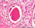 到底是子宫内膜样腺癌还是透明细胞癌图6