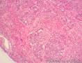 到底是子宫内膜样腺癌还是透明细胞癌图8