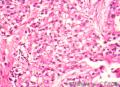 到底是子宫内膜样腺癌还是透明细胞癌图4