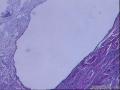 各位老师：盆腔小肿物又传新图，是否考虑浆液性腺纤维瘤？图20