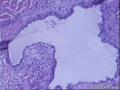 各位老师：盆腔小肿物又传新图，是否考虑浆液性腺纤维瘤？图28