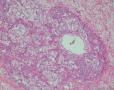 右卵巢卵黄囊瘤：图37