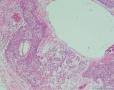 右卵巢卵黄囊瘤：图21
