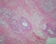右卵巢卵黄囊瘤：图38