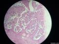 微信病例3 ｜交界性浆液性乳头状囊腺瘤图2