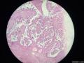 微信病例3 ｜交界性浆液性乳头状囊腺瘤图3