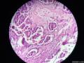 微信病例3 ｜交界性浆液性乳头状囊腺瘤图4