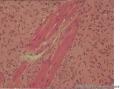 神经纤维瘤？包绕皮肤附件，这些是平滑肌还是胶原纤维？图7