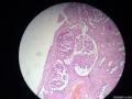 微信病例3 ｜交界性浆液性乳头状囊腺瘤图8