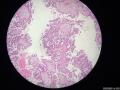 微信病例3 ｜交界性浆液性乳头状囊腺瘤图7