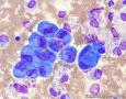 血性胸水，间皮细胞还是瘤细胞？图18