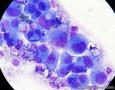 血性胸水，间皮细胞还是瘤细胞？图7