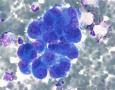 血性胸水，间皮细胞还是瘤细胞？图12
