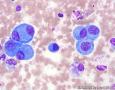 血性胸水，间皮细胞还是瘤细胞？图17