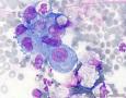 血性胸水，间皮细胞还是瘤细胞？图3