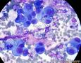 血性胸水，间皮细胞还是瘤细胞？图4