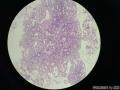 微信病例10 ｜无非典型性子宫内膜增生（子宫内膜复杂性增生 )图5