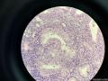 微信病例10 ｜无非典型性子宫内膜增生（子宫内膜复杂性增生 )图3