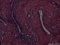 左手指包块，是腱鞘纤维瘤吗，为什么会有那么多的淋巴细胞。图7