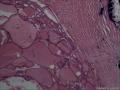 滤泡性腺瘤，为什么会有那么多的钙化。图14
