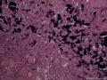 滤泡性腺瘤，为什么会有那么多的钙化。图20