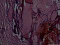 滤泡性腺瘤，为什么会有那么多的钙化。图3