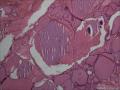 滤泡性腺瘤，为什么会有那么多的钙化。图22