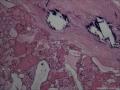 滤泡性腺瘤，为什么会有那么多的钙化。图12