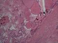 滤泡性腺瘤，为什么会有那么多的钙化。图23