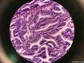 微信病例16   79岁有高级尿路上皮癌的病史。图5