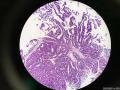 微信病例16   79岁有高级尿路上皮癌的病史。图1