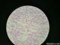 微信病例28 | 冰冻卵巢肿物，直径10cm，切面金黄色，多结节状！图3