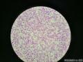 微信病例28 | 冰冻卵巢肿物，直径10cm，切面金黄色，多结节状！图7