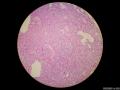 微信病例29 | 年轻人卵巢复杂的性索间质肿瘤图6
