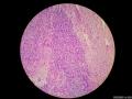 微信病例29 | 年轻人卵巢复杂的性索间质肿瘤图5
