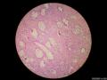 微信病例29 | 年轻人卵巢复杂的性索间质肿瘤图8
